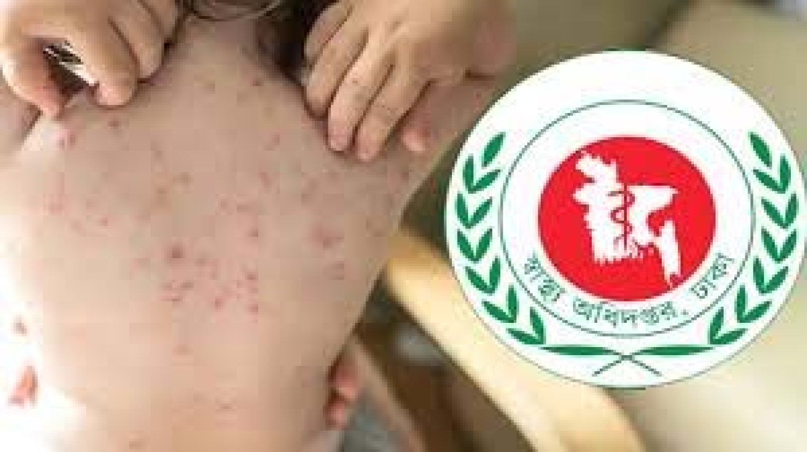 হাম ও হামের উপসর্গে ২৪ ঘণ্টায়  আরও ৭ শিশুর মৃত্যু