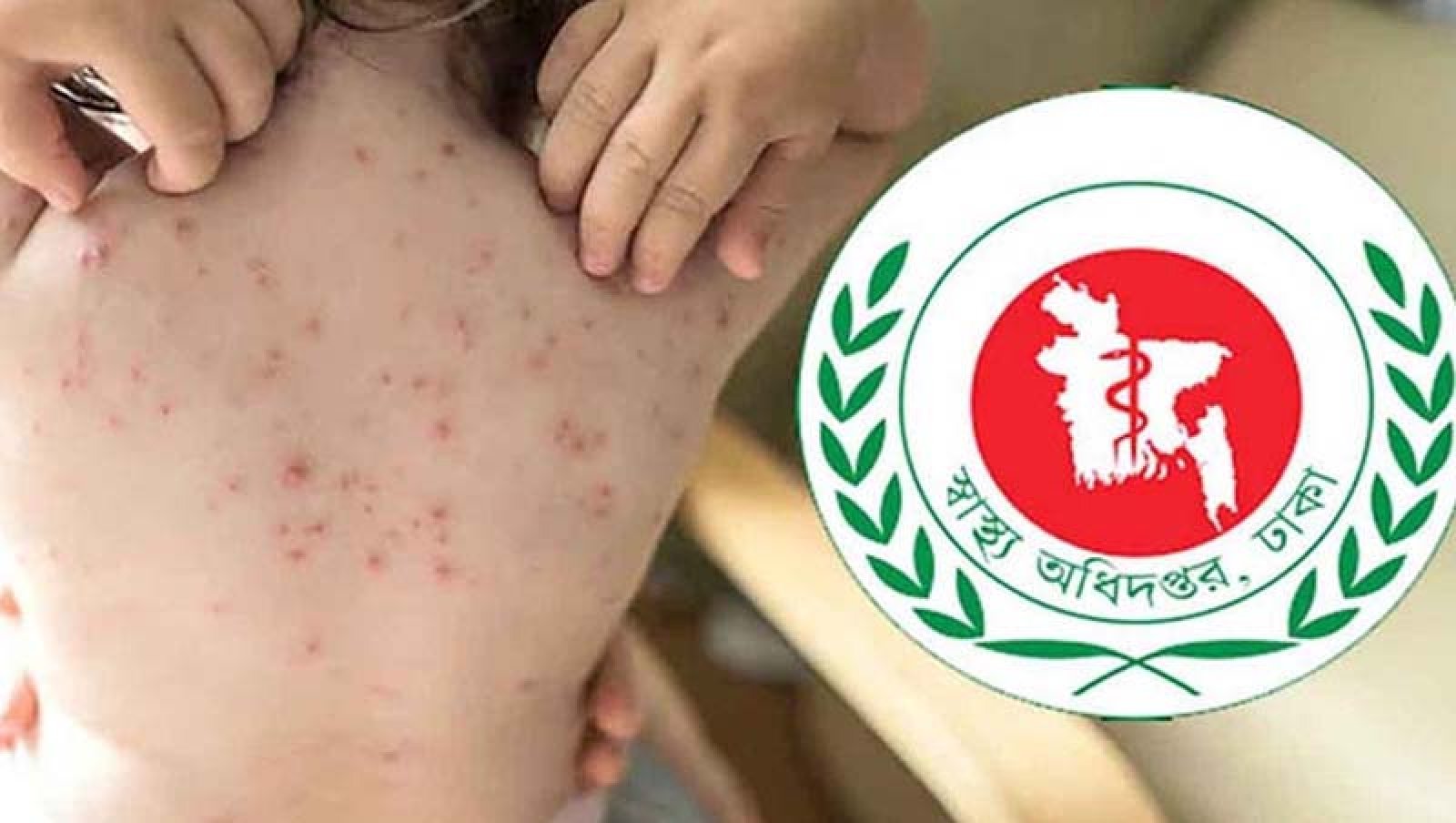 হামের উপসর্গ নিয়ে আরও পাঁচ শিশুর মৃত্যু