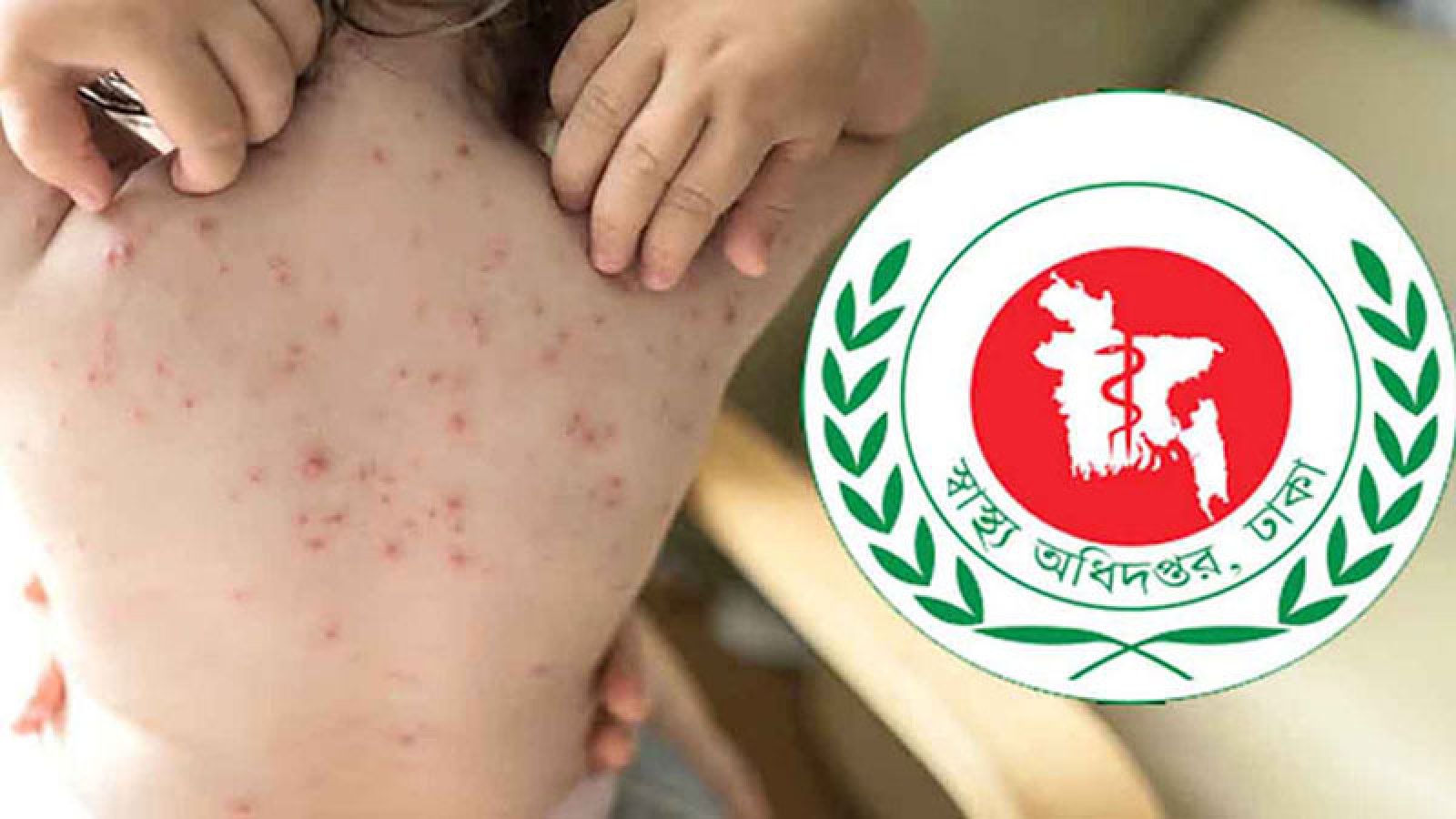 হাম ও হামের উপসর্গে আরও তিন জনের মৃত্যু