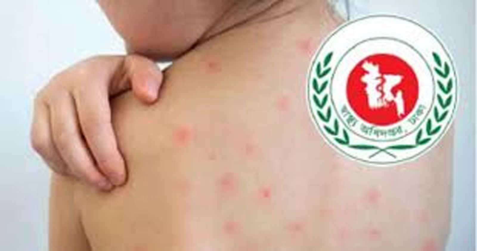 হাম ও হাম সন্দেহে শিশু মৃত্যু আড়াইশ ছাড়াল