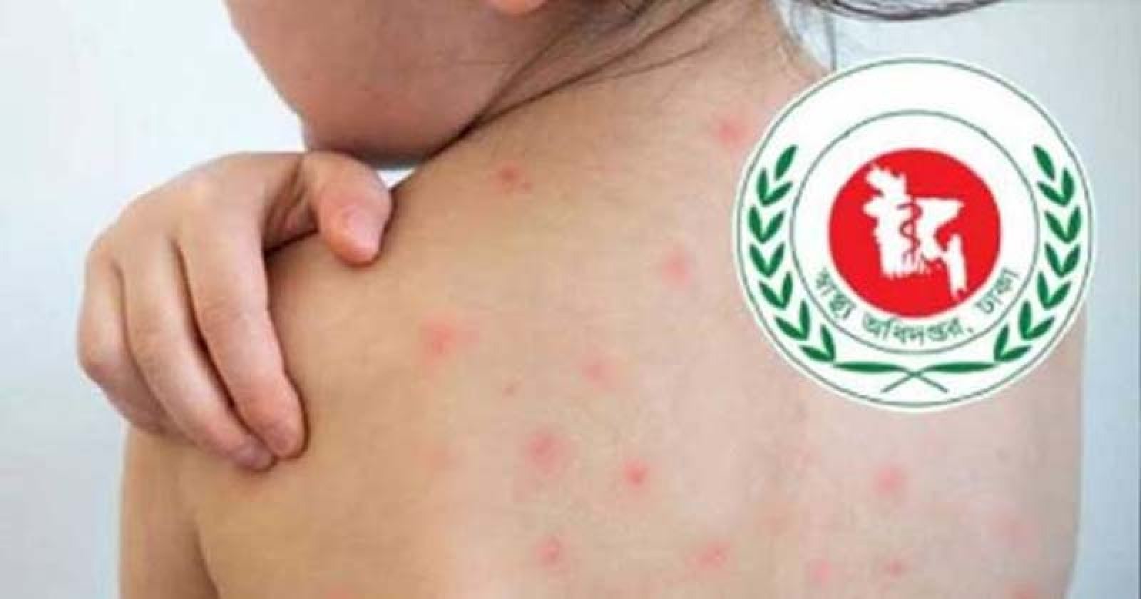 হামের উপসর্গ নিয়ে  ১১ শিশুর মৃত্যু