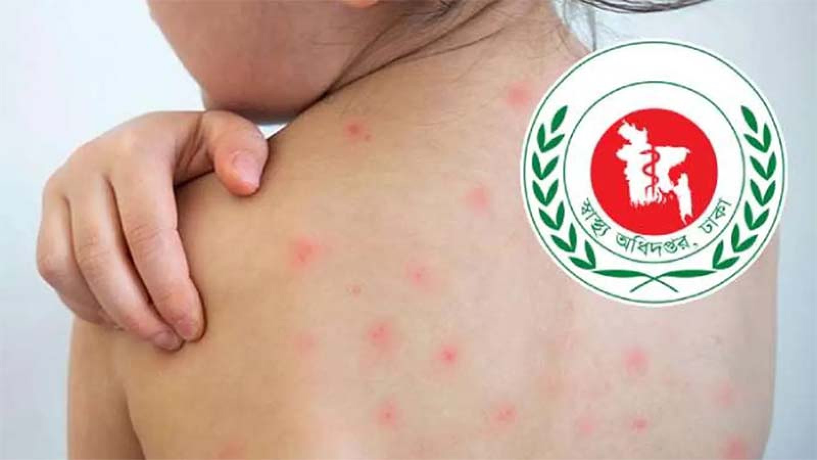 হাম উপসর্গে নিয়ে আরও পাঁচজনের মৃত্যু