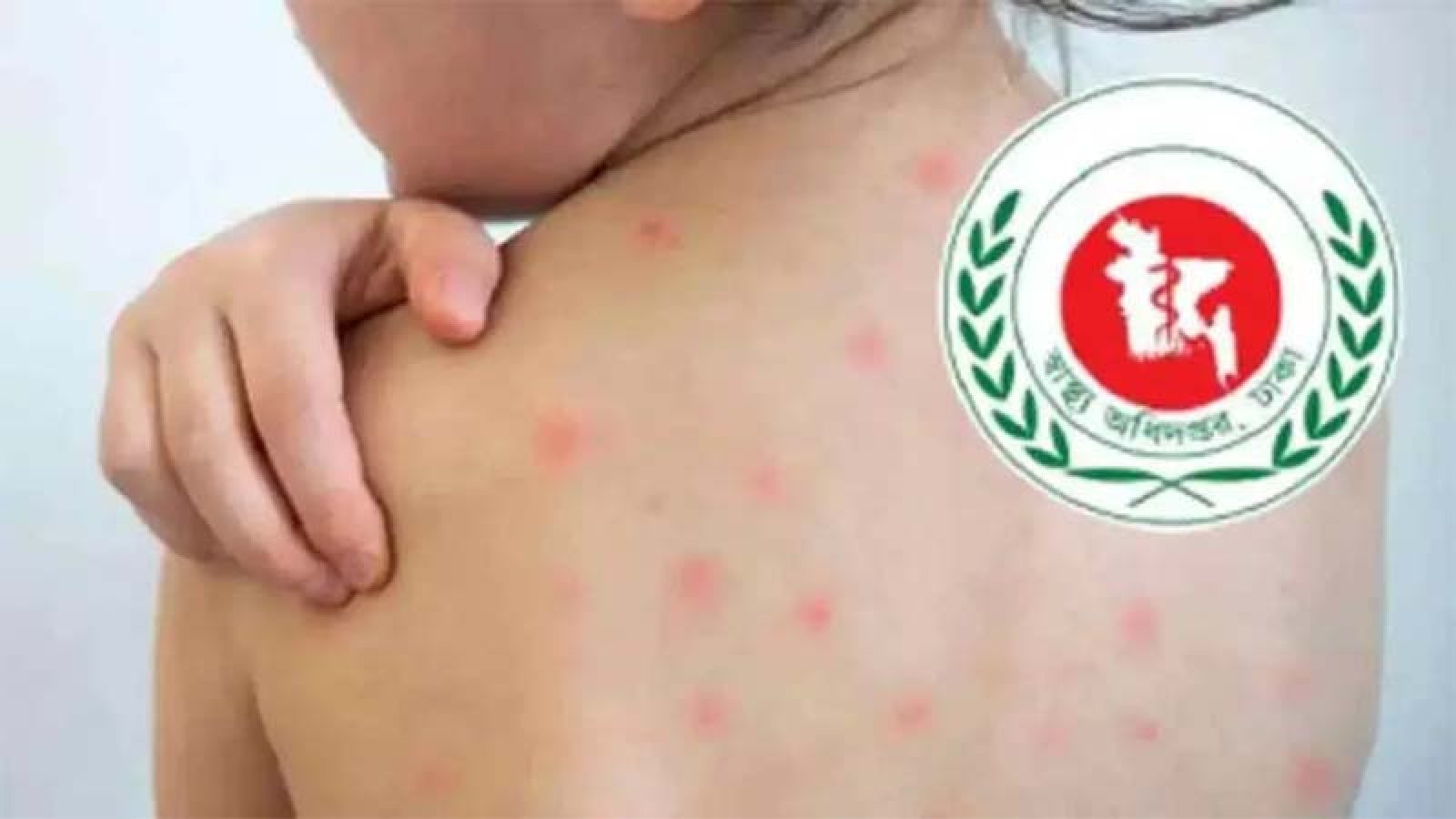 হামের উপসর্গ নিয়ে আরও ৬ শিশুর মৃত্যু