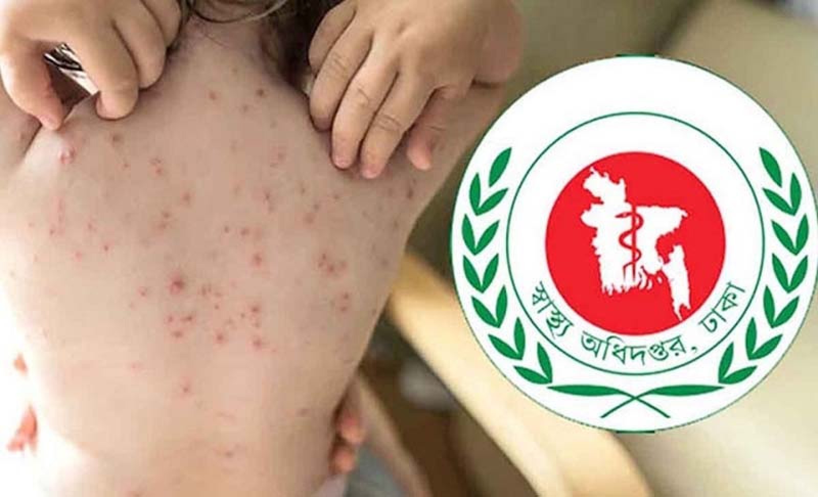 হামের উপসর্গ নিয়ে আরও আট শিশুর মৃত্যু