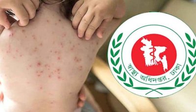 হামের উপসর্গ নিয়ে আরও পাঁচ শিশুর মৃত্যু