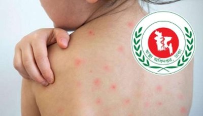 হাম ও  উপসর্গে  নিয়ে আরও ৮ শিশুর মৃত্যু