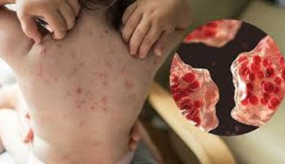 প্রায় নির্মূল হওয়া হাম আবার দেশে দেশে ফিরছে কেন