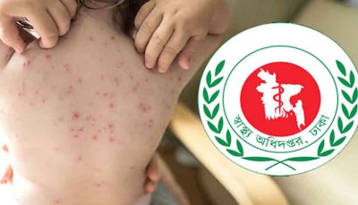 হাম ও হামের উপসর্গে আরও তিন জনের মৃত্যু