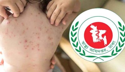হাম ও হামের উপসর্গ নিয়ে দেশে মৃত্যু ছাড়ালো ১১০০