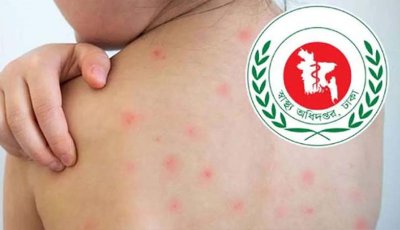 হাম উপসর্গে নিয়ে  আরও ৫ জনের মৃত্যু