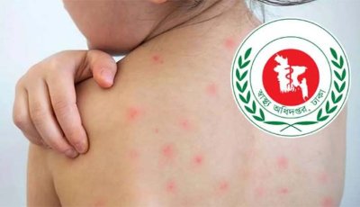 হাম উপসর্গে নিয়ে আরও পাঁচজনের মৃত্যু