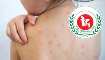 হামের উপসর্গ নিয়ে আরও ৬ শিশুর মৃত্যু